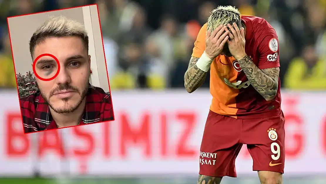 Elmacık Kemiği Kırılan Icardi Süper Kupa'da Oynayacak mı?