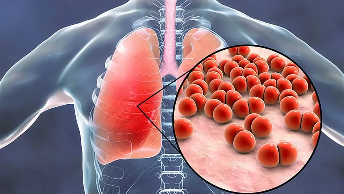 Pnömoni nedir? Gizli Zatürre denen hastalık nasıl bulaşır?