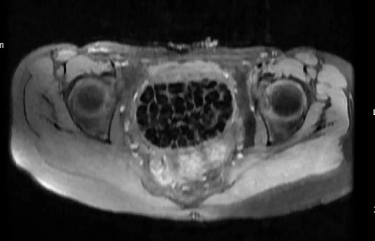 Genç kızın vücudundan 287 tane taş çıkarıldı!
