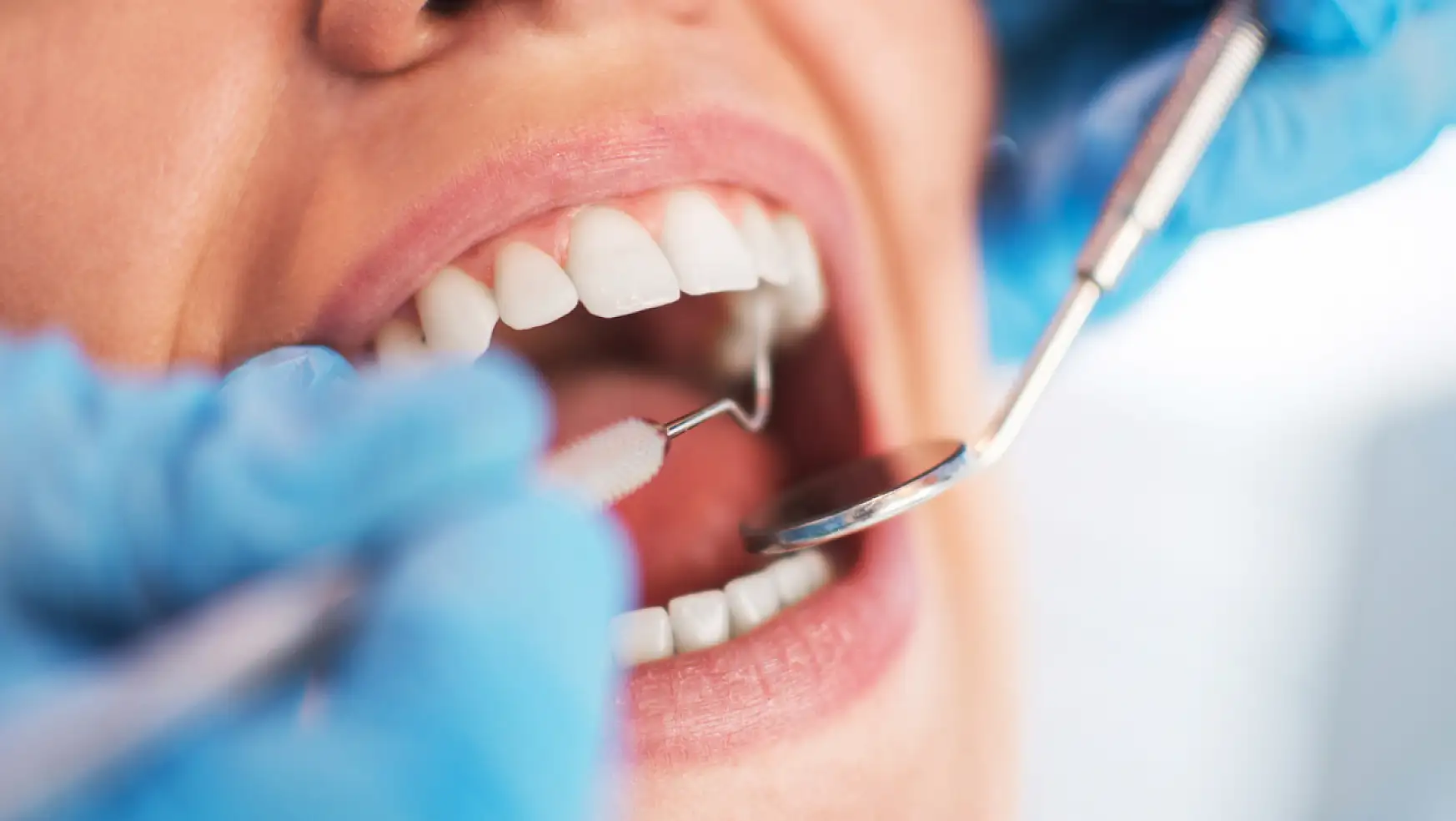 Çürük Diş Belirtileri Nasıl Olur? Dişteki Çürük Belirtileri Nasıl Anlaşılır?