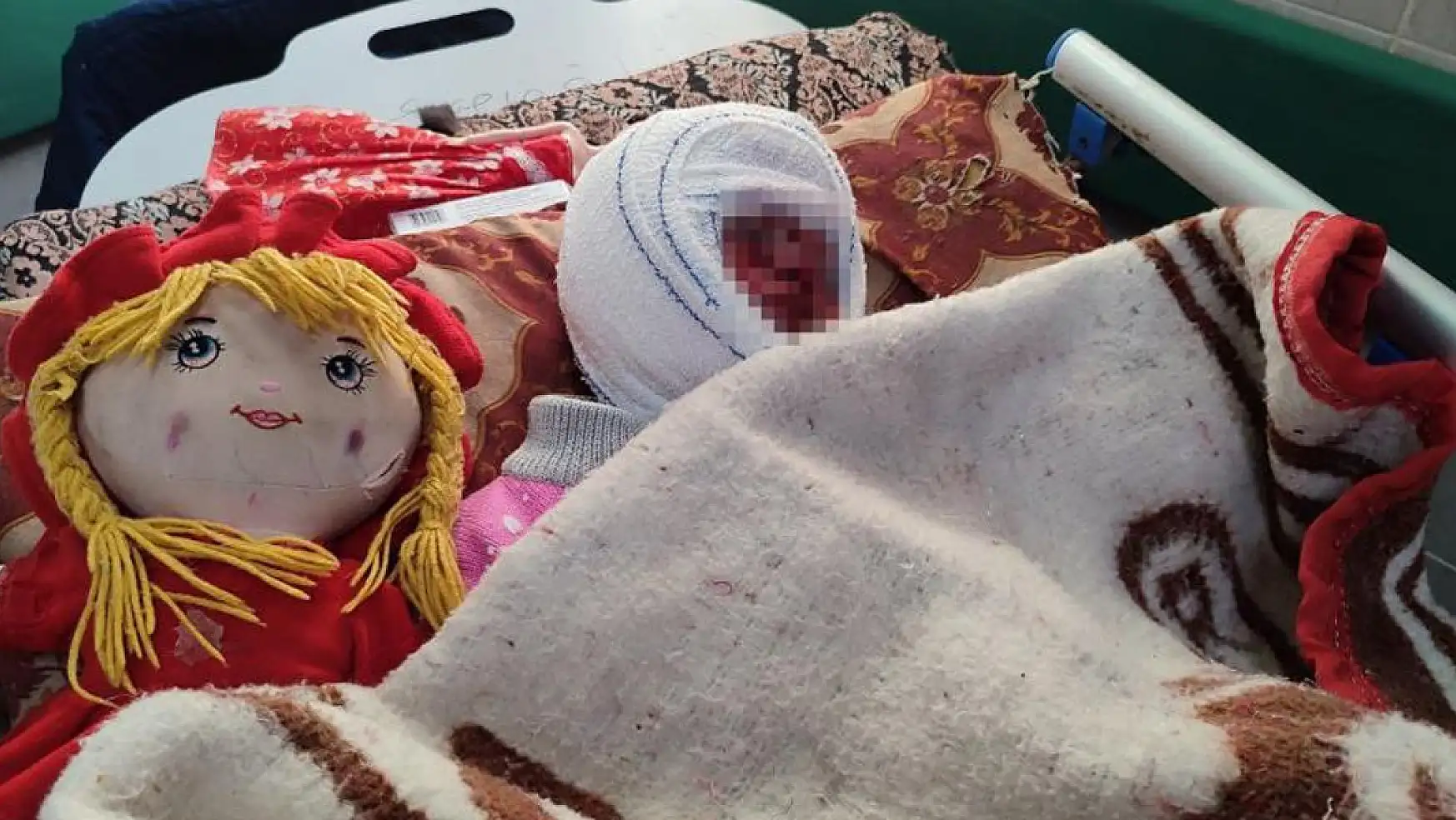 İsrail Saldırılarında Yüzü Yanan 4 Yaşındaki Seca Yardım Bekliyor