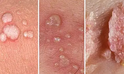 Milyonları korkutan HPV kabusu Türkiye'de de mi görüldü?