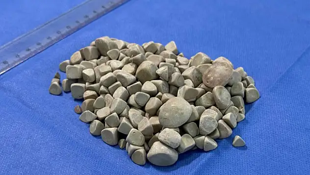 Genç kızın vücudundan 287 tane taş çıkarıldı!