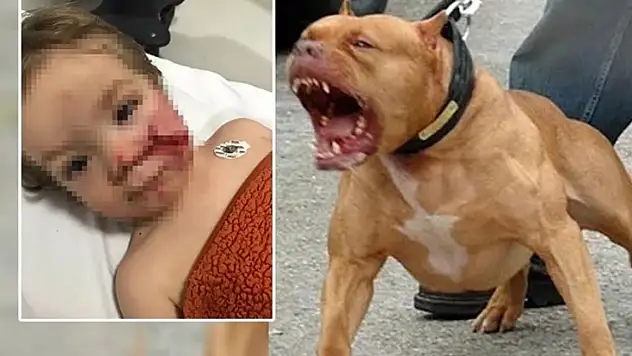 pitbull Dehşeti Çocuğun Yüzü Paramparça Oldu