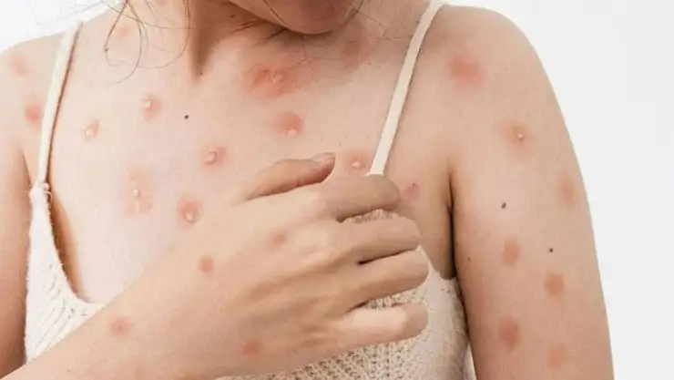 Ankara'da 4 Kişide Maymun Çiçeği Hastalığı mı Görüldü? Sağlık Müdürlüğü Açıklama Yaptı!