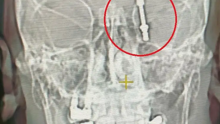 Dişini Yaptırmak İstemişti! İmplant Tedavisinde Vida Beynine Saplandı