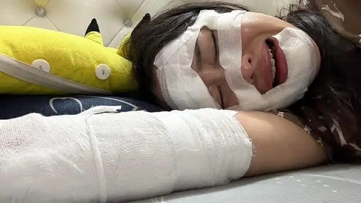 Doğum gününde elinde patlayan balon kadının yüzü yandı