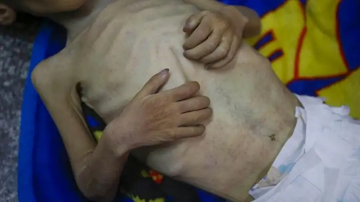 Gazze'de 6 kişi daha açlıktan öldü!