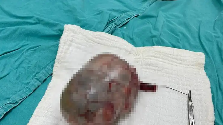 İdrar şikayetinin ardından 20 santimlik tümör çıktı!