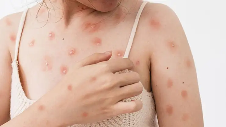 Maymun Çiçeği-Mpox Vakası Türkiye'de Var Mı? Sağlık Bakanlığı Açıkladı