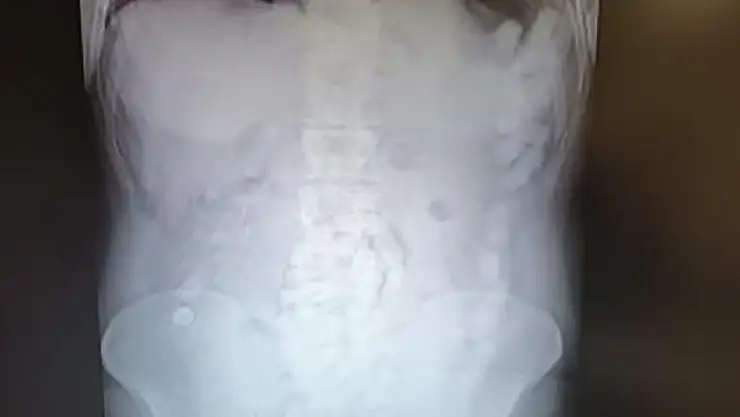 Midesinden Çıkanlar Şok Etti: Toplam 100 Adet Operasyonla Çıkarıldı