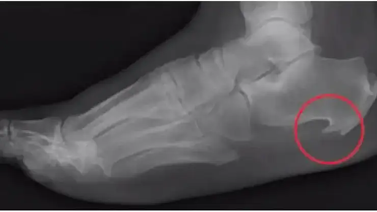 Uzun süre ayakta kalanlara dikkat! Bu hastalık sizde olabilir